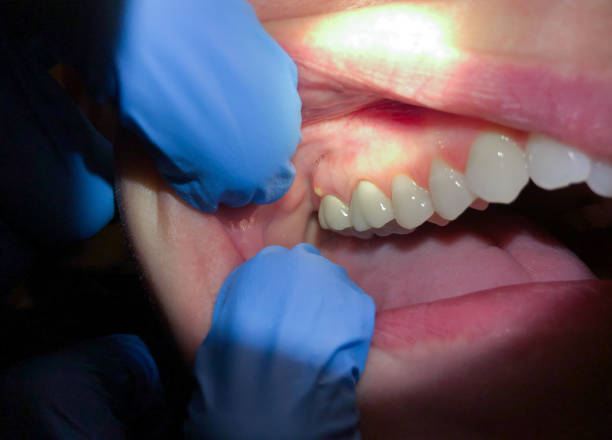 Best Emergency Treatment for Dental Infections or Abscesses in Penngrove, CA