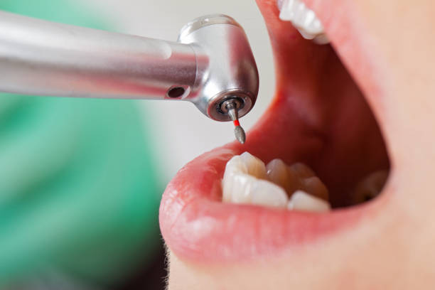 Best Emergency Root Canal Treatment in Penngrove, CA